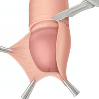 Cirugía de circuncisión